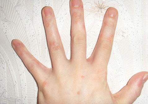 牛皮皮癣初期症状图片8粉红色斑点