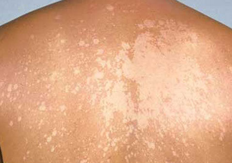 背部汗斑花斑癣的症状图片