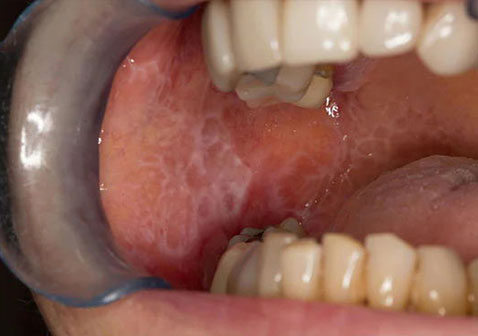 舌癌的早期症状图片