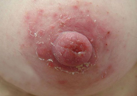 什么是乳房湿疹（附图片）