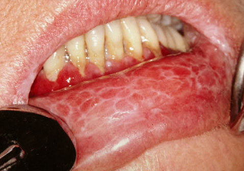 口腔粘膜苔藓病变图片图片