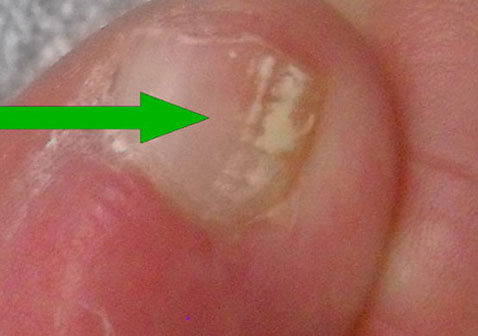 白色浅表灰指甲初期症状图片
