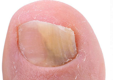 被白色浅表灰指甲感染的一半的脚趾甲图片