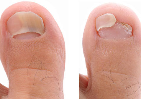 不同阶段的白色表浅灰指甲症状图片