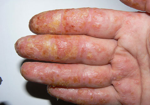 湿疹后期鳞屑结痂图片图片