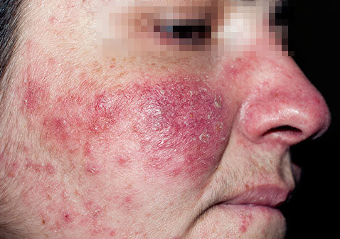 脸湿疹的症状图片图片