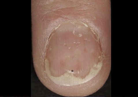 指甲牛皮癣银屑病早期症状图片2