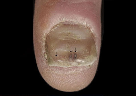 指甲牛皮癣银屑病早期症状图片4