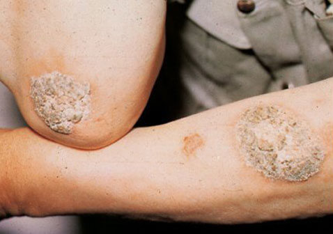 真菌性皮肤病 识别图片