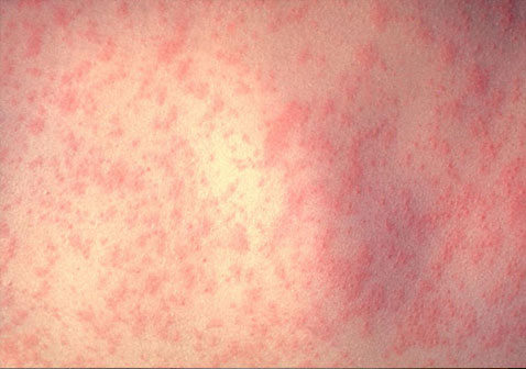 皮肤病图片对照查看图片大全-风疹症状图片