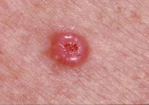 皮肤病图片对照查看图片大全-基底细胞癌症状图片