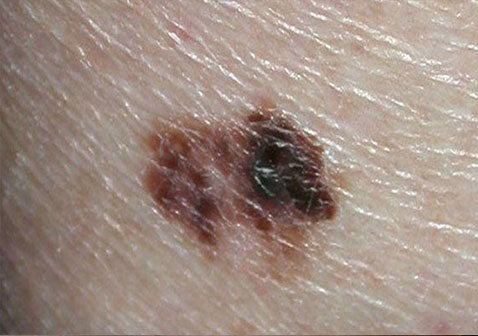 皮肤病图片对照查看图片大全-黑色素瘤症状图片
