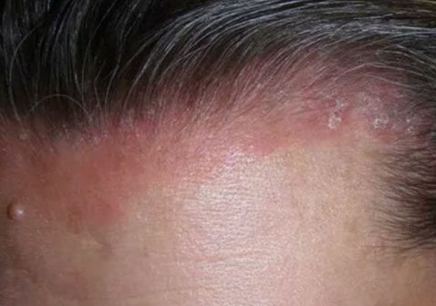 头皮湿疹红斑症状图片