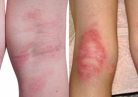 腿上过敏性皮炎皮疹与牛皮癣区别图片对比