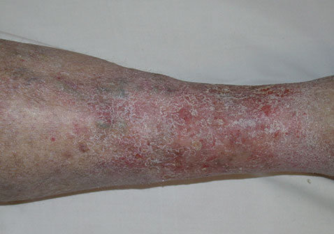 湿疹类型-瘀滞性湿疹症状图片
