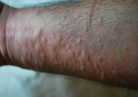 手臂上荨麻疹图片和症状疙瘩