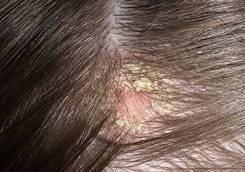 头部脂溢性皮炎是什么样子:原因症状和治疗方法