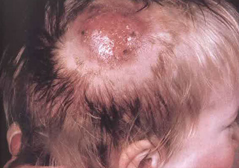 头皮癣：脓疱型，炎性肿瘤