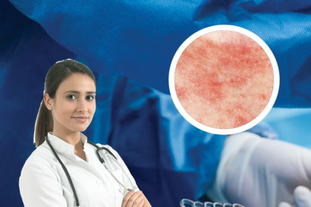 湿疹是否可以用生物单抗治疗