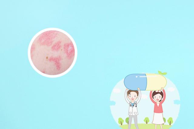 新生儿湿疹怎么处理最好办法