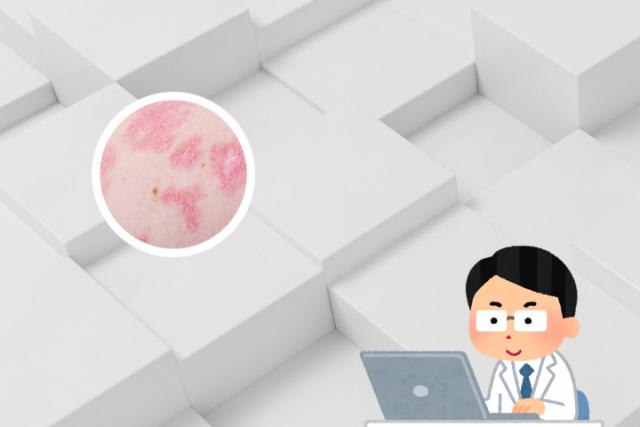 湿疹和皮癣怎么区别