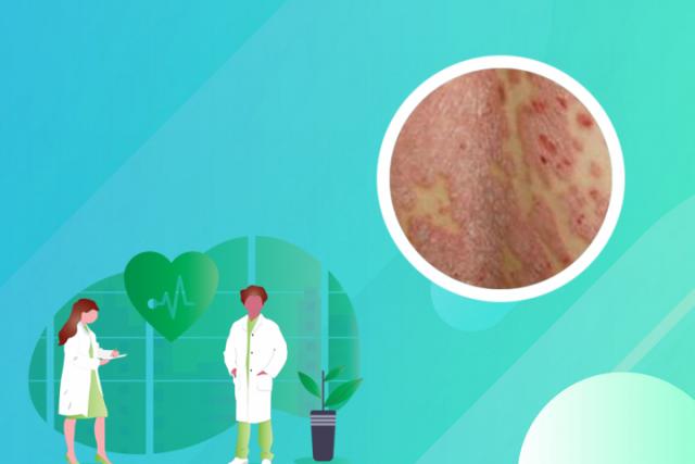 皮炎湿疹的症状有哪些 怎么治疗呢