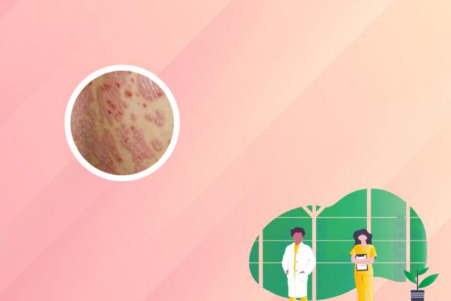 新生儿湿疹和热疹的区别及图片