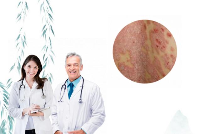 常见热疹分为五种类型图片