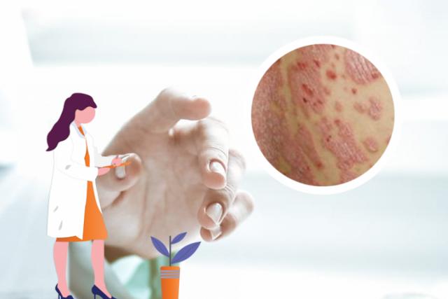 湿疹产生的原因及治疗