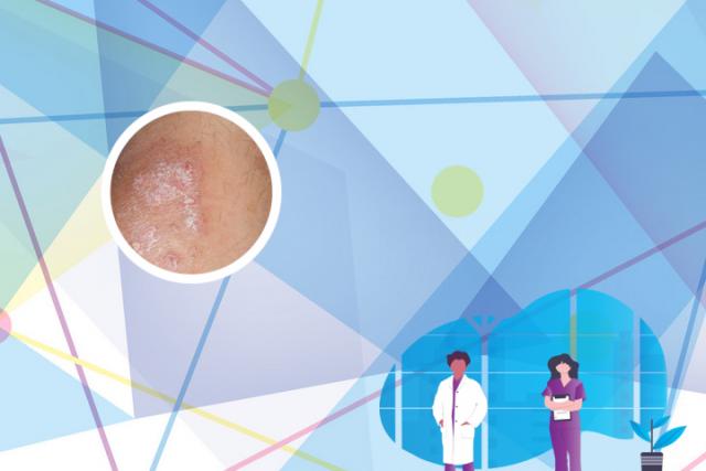 什么原因引起的湿疹有什么办法解决