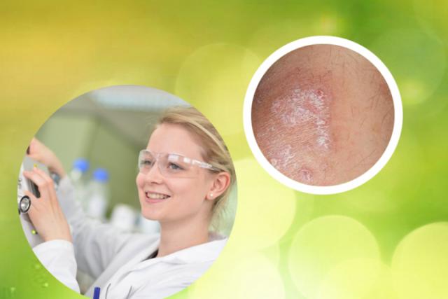 皮肤癣菌感染为什么