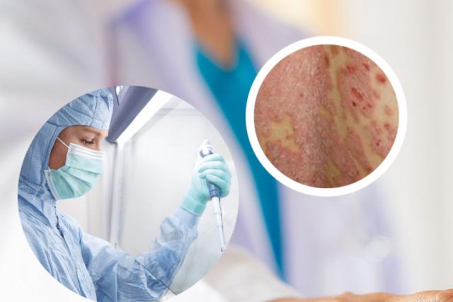 湿疹是什么原因导致的呢