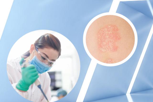 湿疹是什么原因引起的怎么治疗