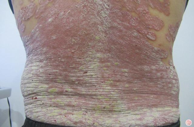 副银屑病会发展成皮肤癌吗