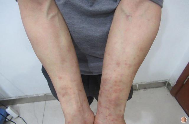 丘疹荨麻疹和银屑病的区别