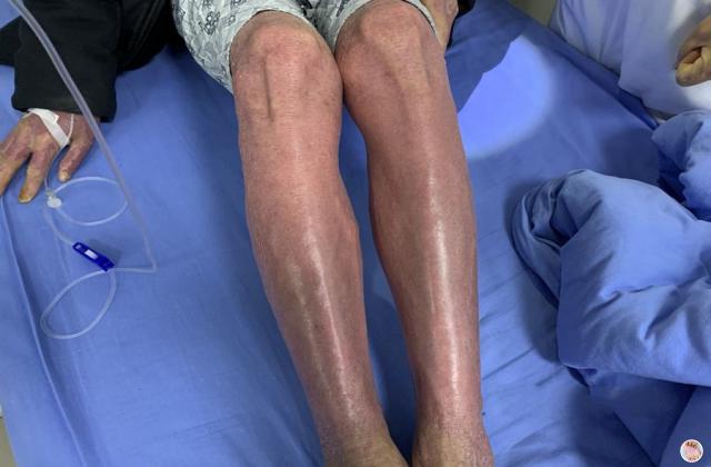 大腿上长牛皮癣治疗过程