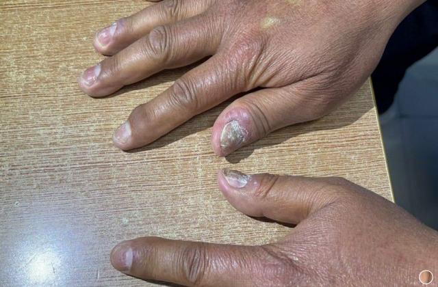 银屑病指甲能吃消炎药吗